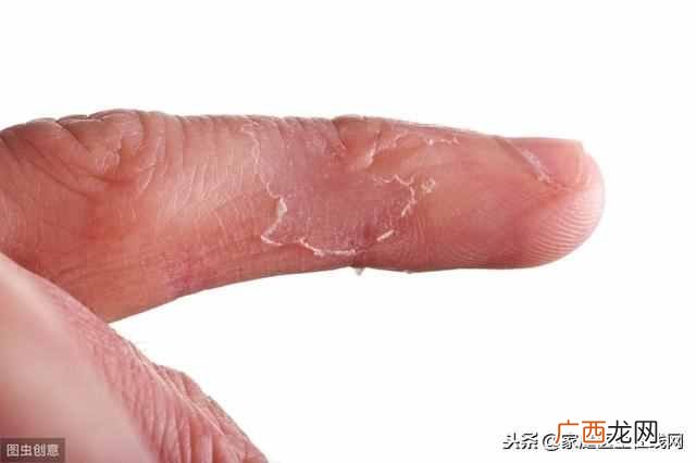 手掌脱皮是什么原因？通常是缺乏这种维生素，补一补就好了