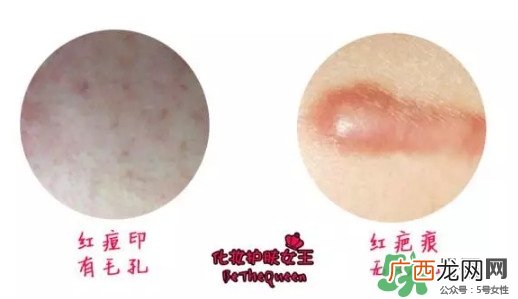 祛红色痘印用什么药膏 各色痘印祛除方法