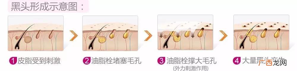 黑头是什么 黑头和毛孔粗大有什么关系