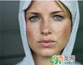 黄褐斑能彻底去除吗?黄褐斑怎么祛除?