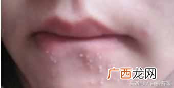 嘴周围长痘痘的原因