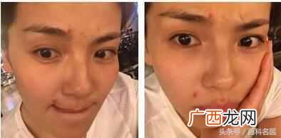 嘴周围长痘痘的原因