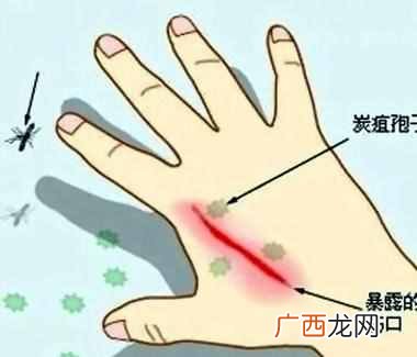 如何预防炭疽病？什么是炭疽病？