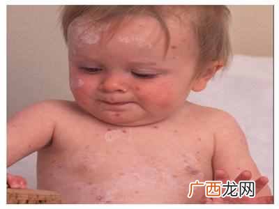 水痘症状？水痘有哪些特别的表现