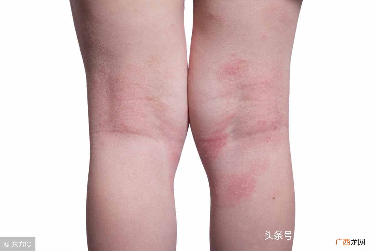 腿上长小红点？腿上起了红疙瘩，还很痒？5个“祸首”