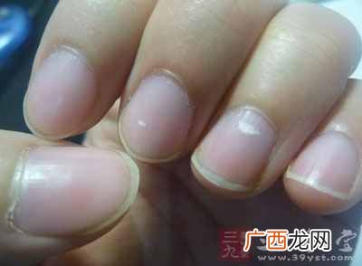 指甲上有白点？指甲上出现白点暗示健康亮“红灯”
