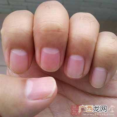 指甲上有白点？指甲上出现白点暗示健康亮“红灯”