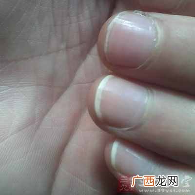指甲上有白点？指甲上出现白点暗示健康亮“红灯”