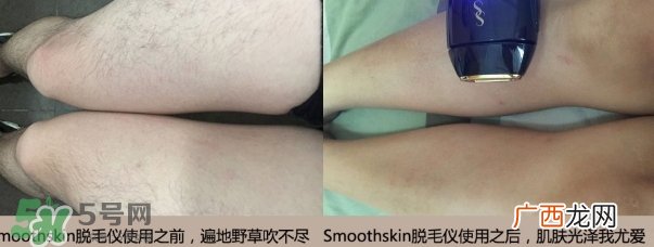 smoothskin和slikn infinity哪个好？smoothskin脱毛仪怎么样