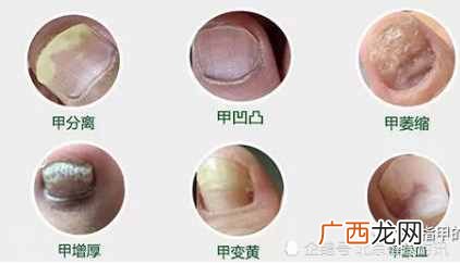 灰指甲的图片？专家教你如何判断自己是不是灰指甲？