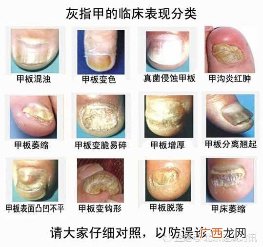 灰指甲的图片？专家教你如何判断自己是不是灰指甲？