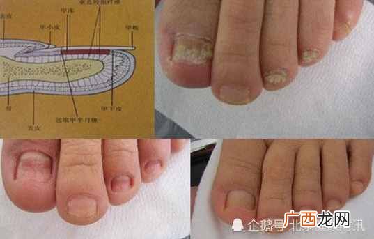 灰指甲的图片？专家教你如何判断自己是不是灰指甲？