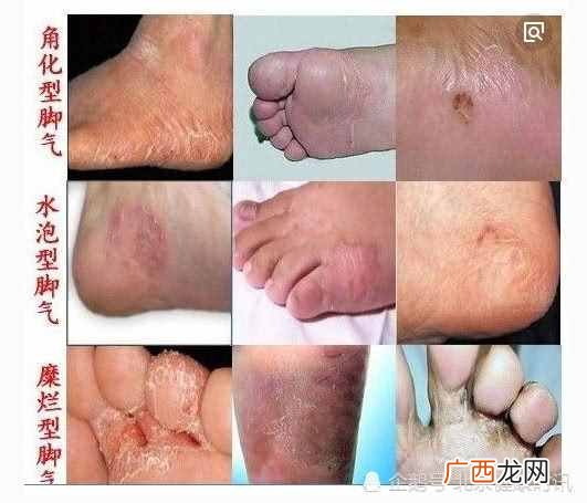灰指甲的图片？专家教你如何判断自己是不是灰指甲？