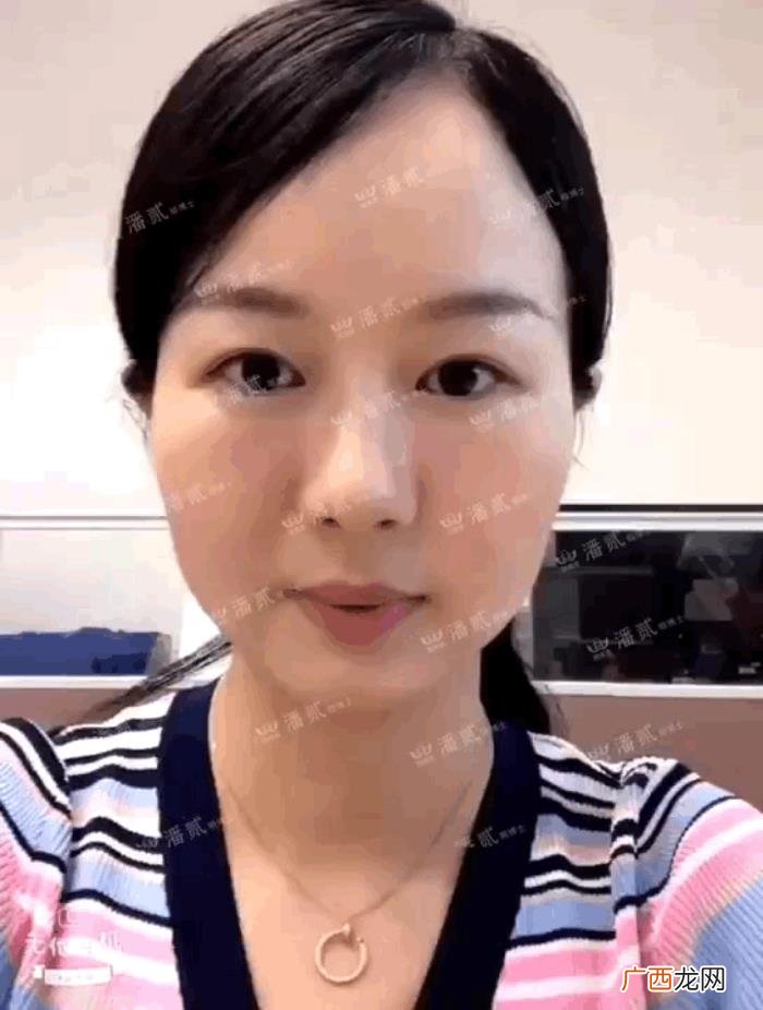 微创双眼皮和全切哪个好，韩式微创三点双眼皮这么好