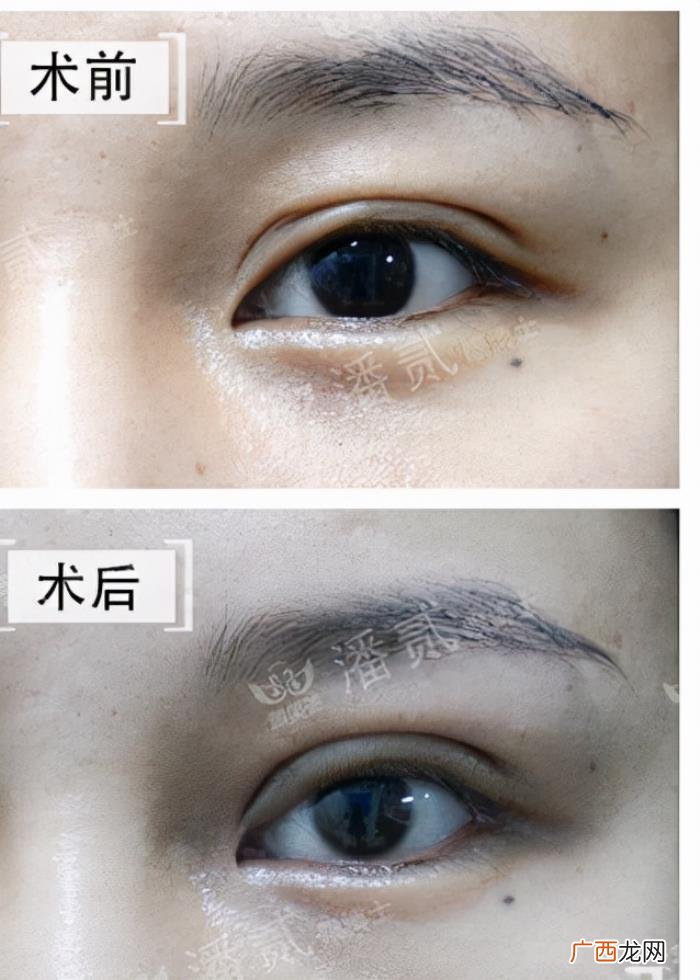 微创双眼皮和全切哪个好，韩式微创三点双眼皮这么好