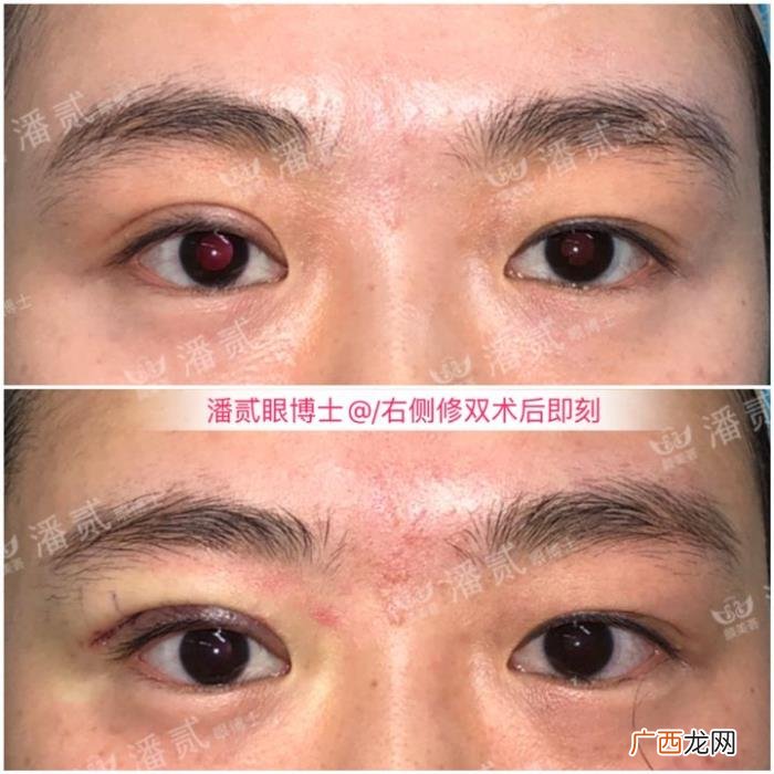 微创双眼皮和全切哪个好，韩式微创三点双眼皮这么好