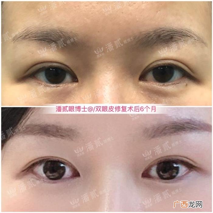 微创双眼皮和全切哪个好，韩式微创三点双眼皮这么好