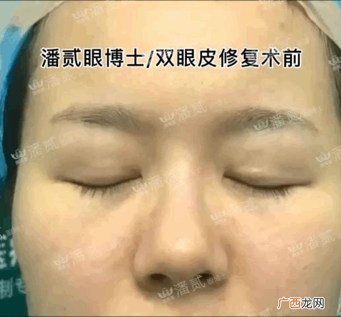 微创双眼皮和全切哪个好，韩式微创三点双眼皮这么好