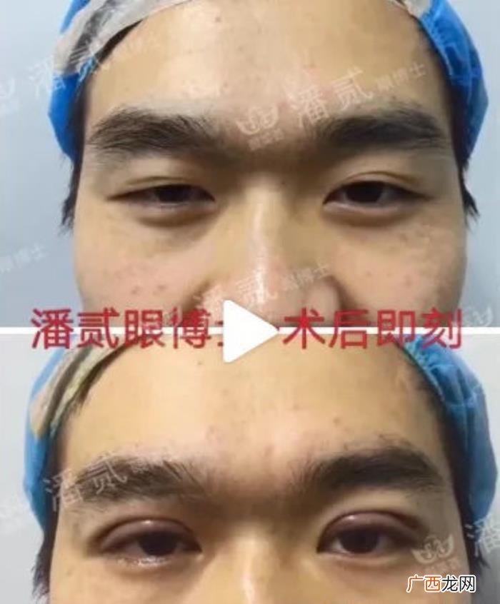 微创双眼皮和全切哪个好，韩式微创三点双眼皮这么好