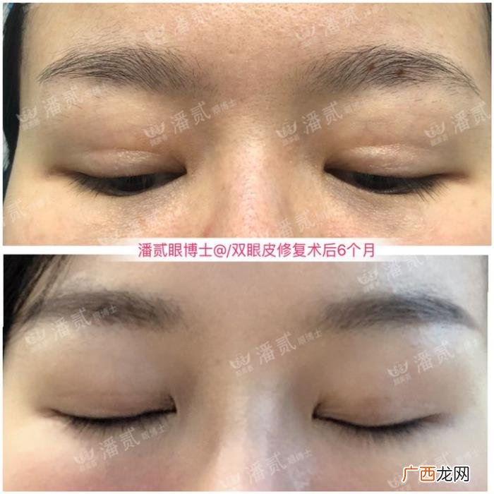 微创双眼皮和全切哪个好，韩式微创三点双眼皮这么好