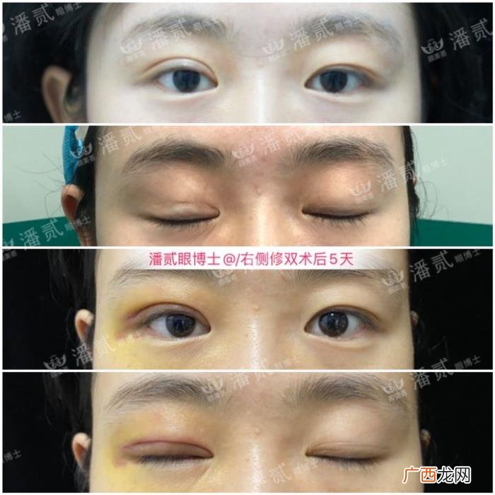 微创双眼皮和全切哪个好，韩式微创三点双眼皮这么好