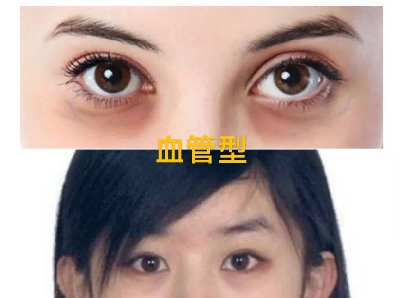 天生黑眼圈，但我的黑眼圈真的是天生的.....