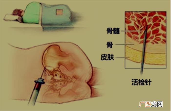 骨髓穿刺术，多学科协作下成功实施骨髓穿刺术1例