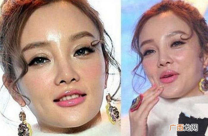 死在整容手术台的明星，有的命丧手术台