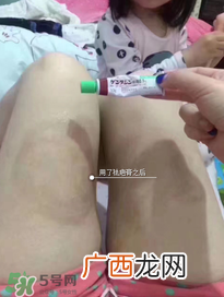 日本msd祛疤膏怎么样？日本msd祛疤膏有用吗？