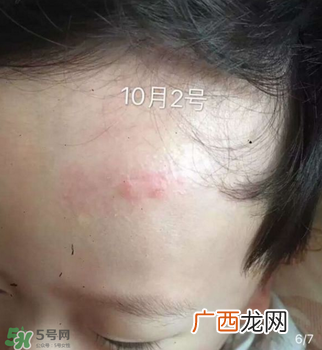 日本msd祛疤膏是抗生素吗？日本msd祛疤膏是不是抗生素？