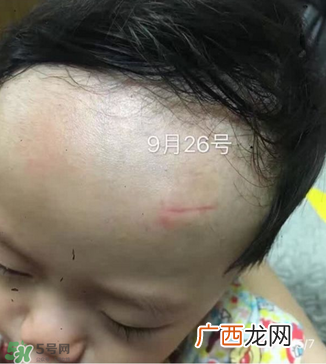 日本msd祛疤膏是抗生素吗？日本msd祛疤膏是不是抗生素？