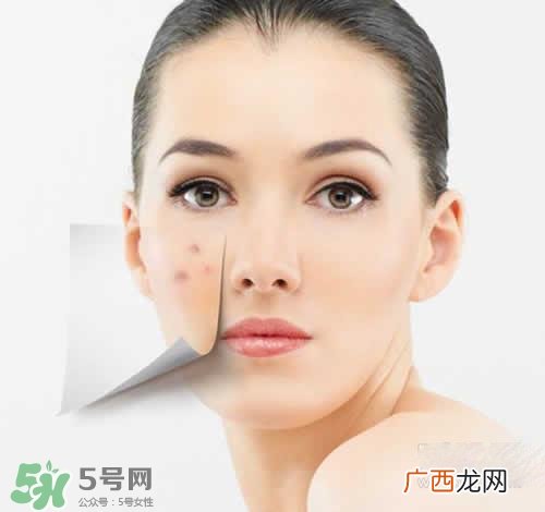 黑色痘印多久会消失？黑色痘印消失时间