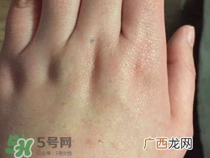 薇诺娜适合什么皮肤？薇诺娜适合敏感肌吗？