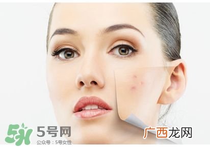 祛痘好方法 祛痘小妙招