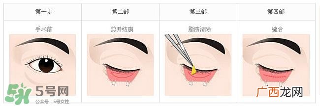 眼袋是怎么形成的?手术去眼袋安全吗