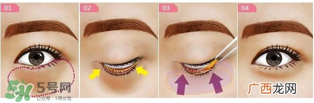 眼袋是怎么形成的?手术去眼袋安全吗