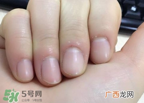 手上长倒刺可以拔吗?手上长倒刺能拔吗?