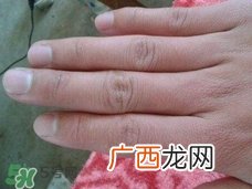 手上长倒刺可以拔吗?手上长倒刺能拔吗?