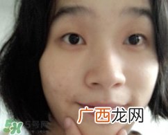 唇周边长痘是什么原因?唇周边长痘是怎么回事?