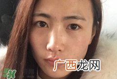 唇周边长痘是什么原因?唇周边长痘是怎么回事?