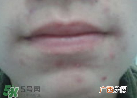唇周边长痘是什么原因?唇周边长痘是怎么回事?