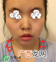 refa去眼袋有效果吗 refa能去眼袋吗
