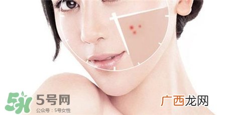 热敷脸可以祛痘吗?热敷脸祛痘好吗?