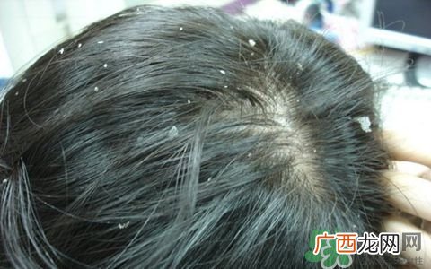 头皮屑多又痒怎么办?头皮屑又多又痒怎么去除?