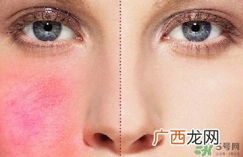 面部红血丝怎么去除?面部红血丝如何改善?