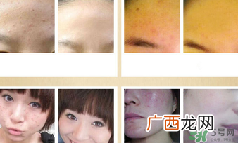 伊诗兰顿祛痘怎么样?伊诗兰顿祛痘膏有用吗?
