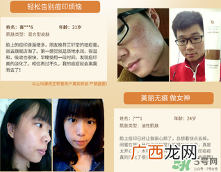 芷轩堂祛痘有效果吗?芷轩堂祛痘印效果怎么样?