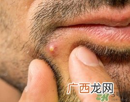 针清痘痘真的能好吗?针清痘痘后几天能好?