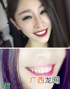 碧缇福冷光牙齿美白仪怎么用？碧缇福冷光牙齿美白仪使用方法