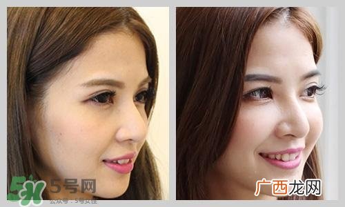 苹果肌下垂怎么提拉上去?苹果肌下垂怎么办?